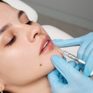Lip Fillers